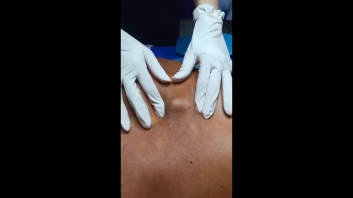 Médico explota gigantesco grano que llevaba 8 años creciendo en la espalda de un hombre