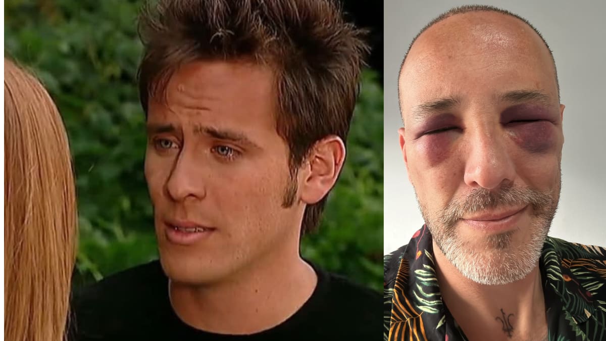 Actor de 'Padres e hijos' se hizo un implante de cabello y su rostro cambió por completo; así quedó
