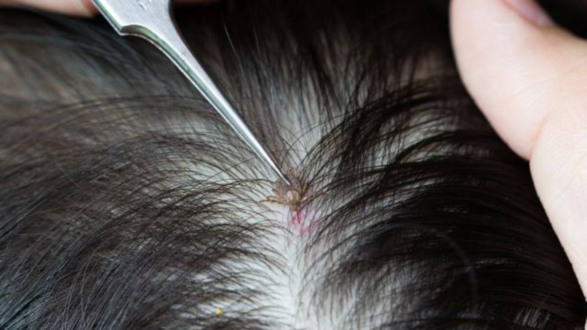 Niña de 12 años muere por picaduras de piojos